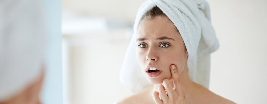 5 Causes of Adult Acne