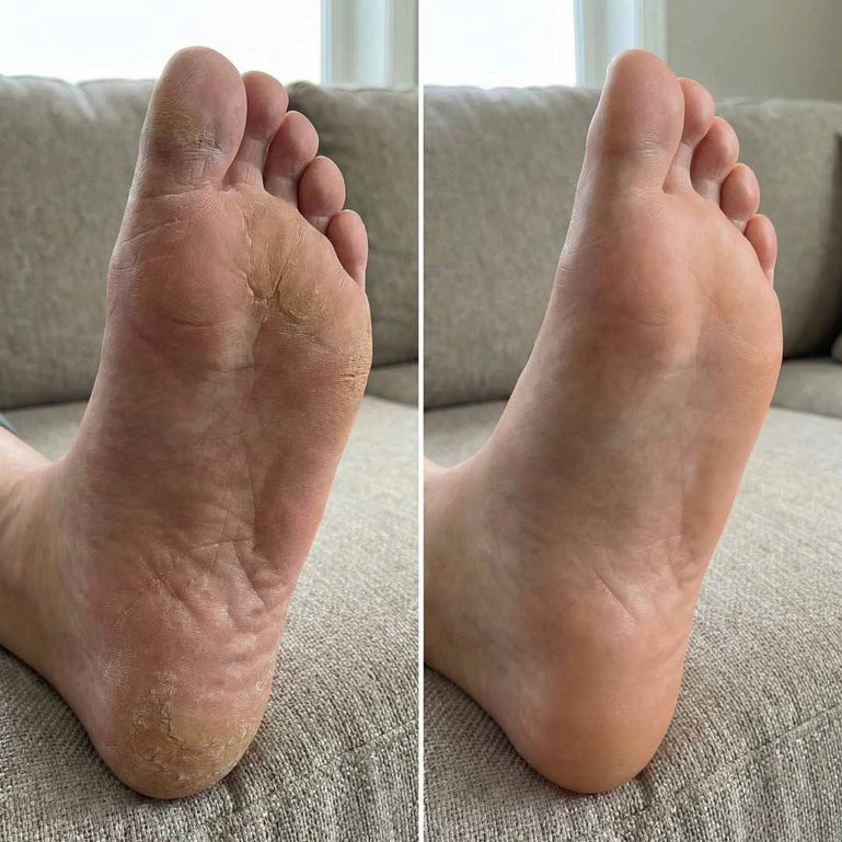 Fancii Cali electric callus remover for feet All