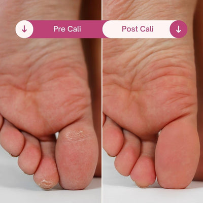 Results of using the Cali callus remover for feet by Fancii and co All
