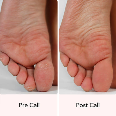 Results of using the Cali callus remover for feet by fancii and coo